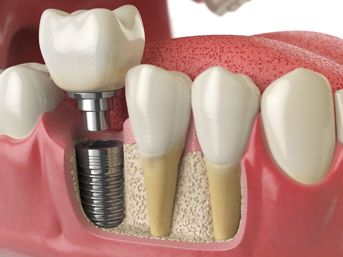 affordable dental implants in mcleansville, north carolina