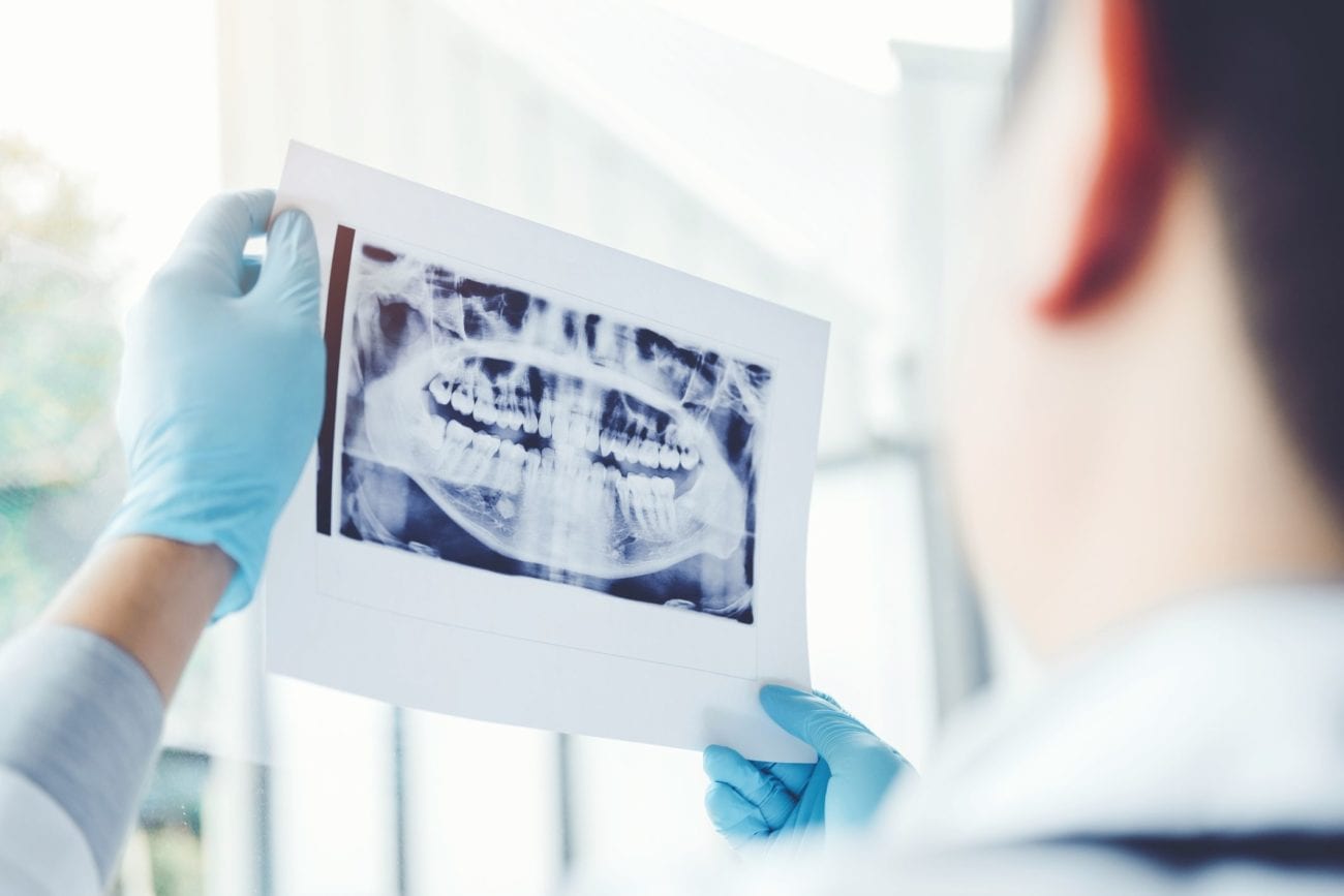 wisdom teeth dentist mcleansville nc
