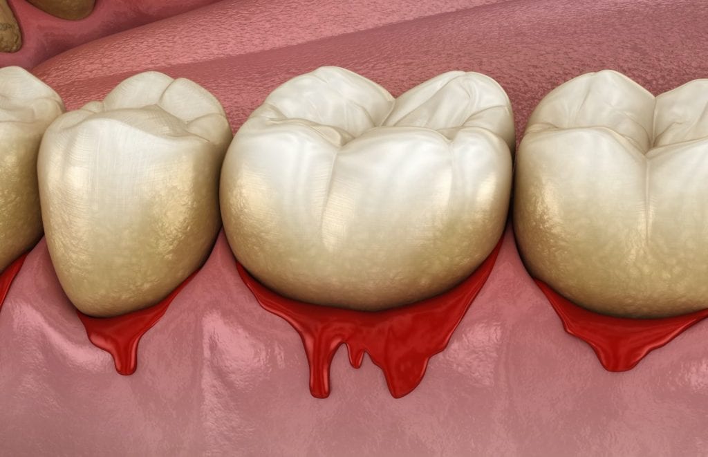 treat bleeding gums in McLeansville North Carolina