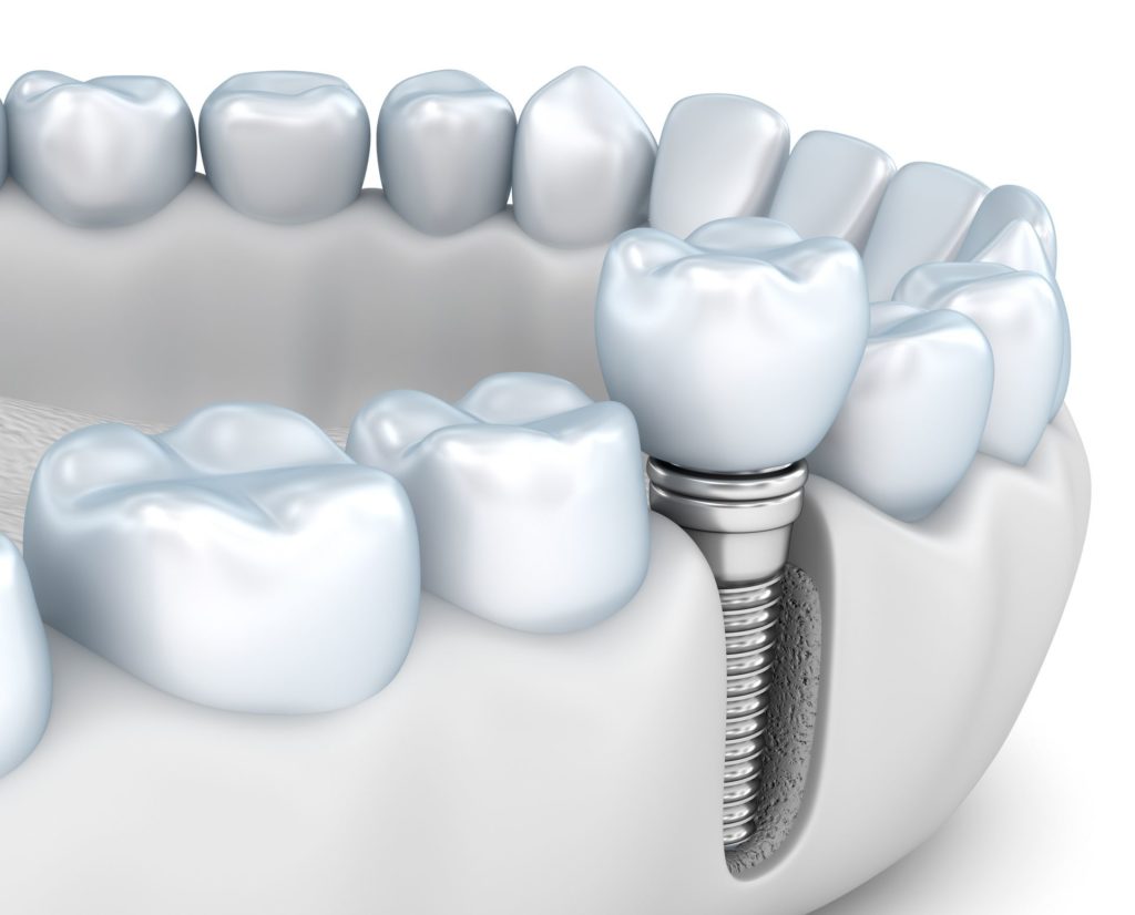 single dental implant in jawbone