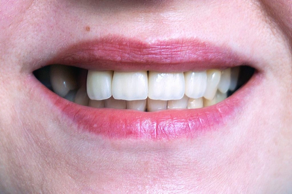treat missing teeth with restorative dentistry