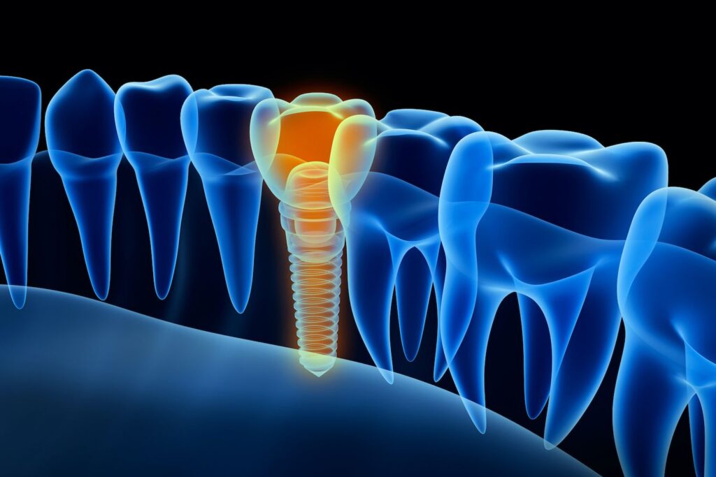 prevent dental implant failure