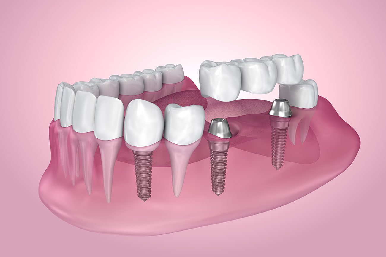 Missing Teeth in McLeansville NC can lead to worsening dental conditions if not treated as soon as possible