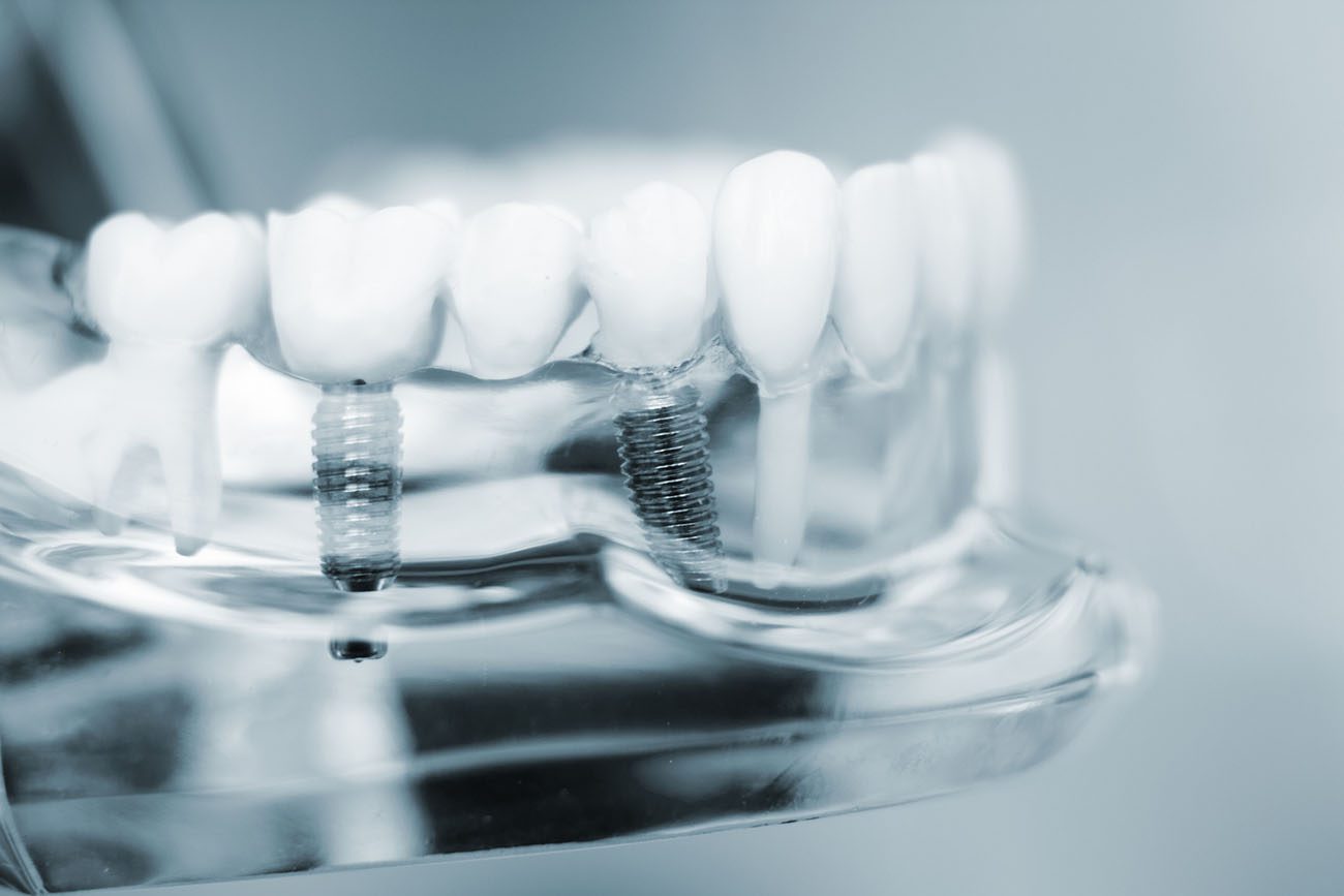 choosing the right Dental Bridge in McLeansville NC is crucial for bite restoration