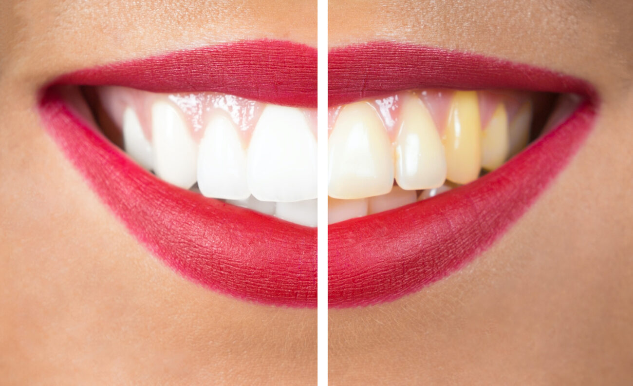 Fortunately, numerous treatment options are available to help restore the brightness of your smile after tooth discoloration.