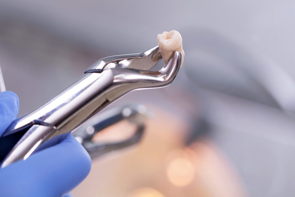 While preserving natural teeth is always the goal, there are situations where tooth extraction becomes necessary.