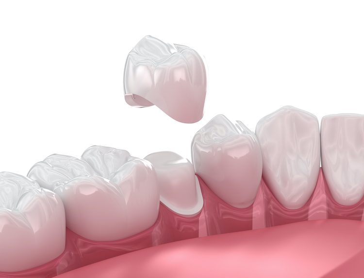 Knowing the appropriate steps after a dental crown falls out could prevent further damage to your tooth and preserve your oral health. 