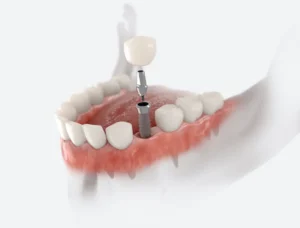 Dental Implants vs. Bridges: Which One? in McLeansville, NC