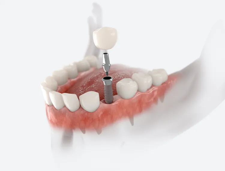 Dental Implants vs. Bridges: Which One? in McLeansville, NC